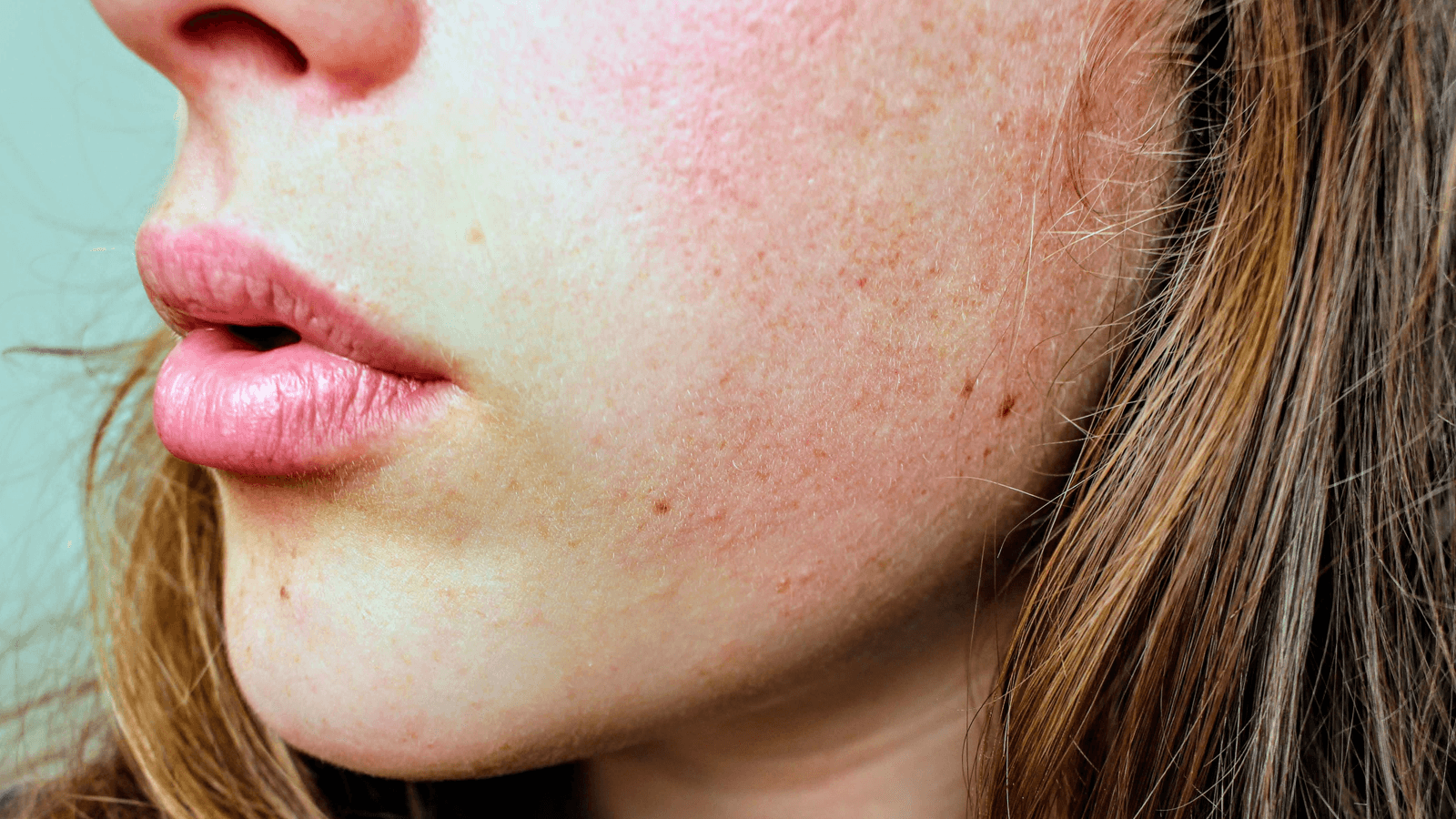 Giai đoạn đầu thường biểu hiện với các lớp vảy da