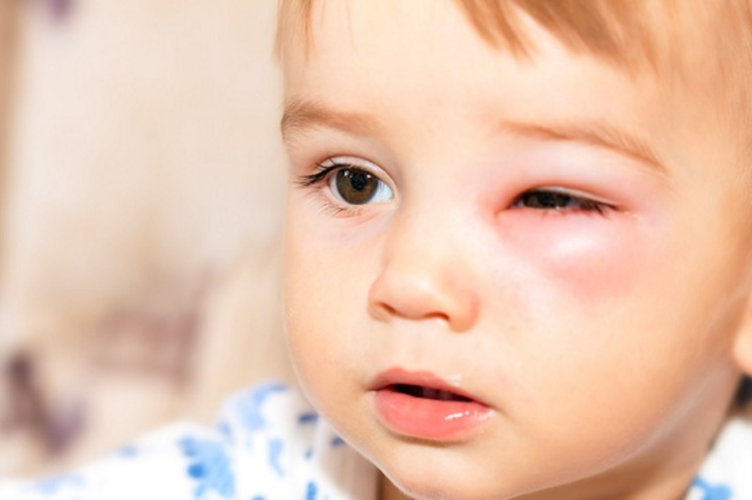 Người lớn cần chú ý những dấu hiệu viêm bờ mi ở trẻ em