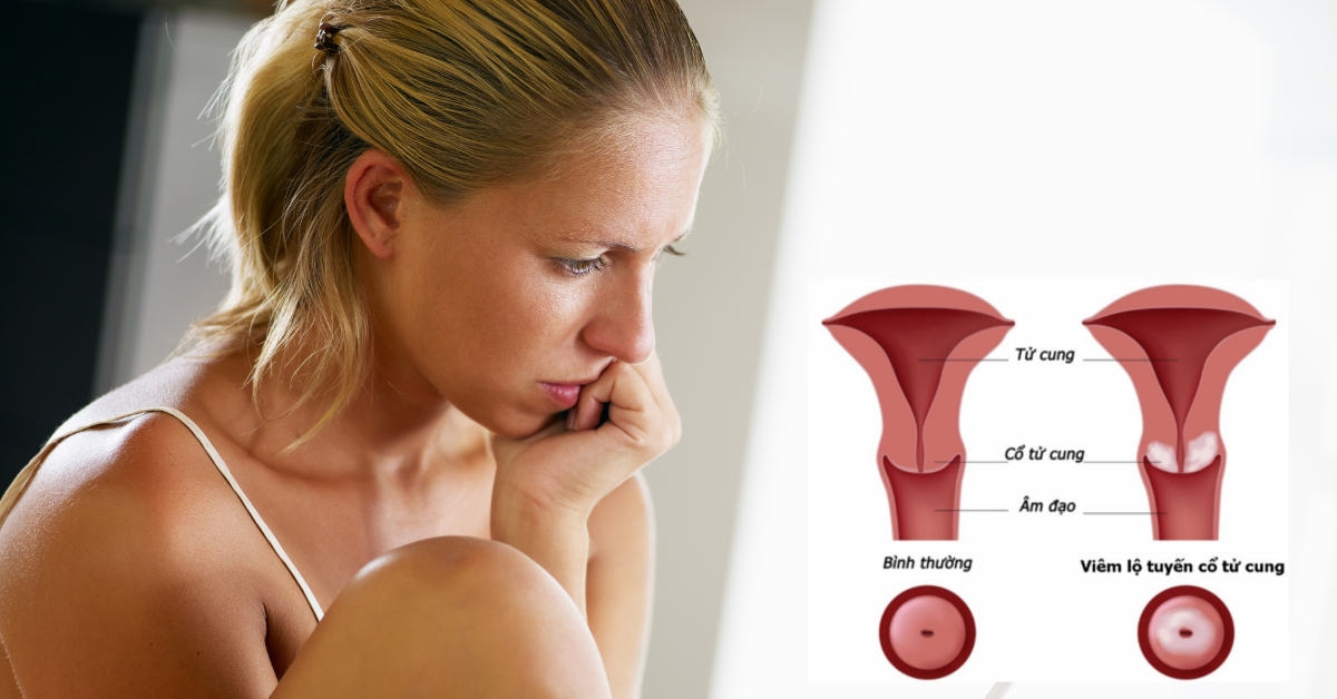 Viêm cổ tử cung có thể mang thai được phụ thuộc vào nhiều yếu tố 