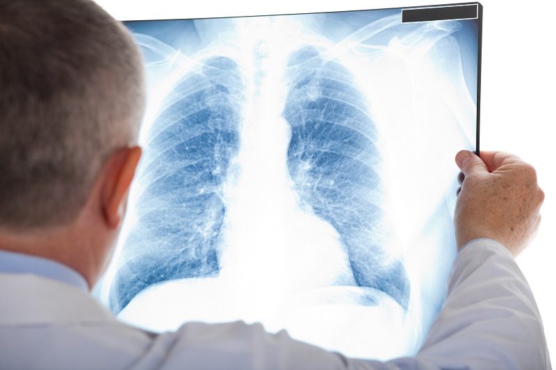 Chụp X quang phổi là việc kiểm tra bắt buộc với người bị bệnh này 