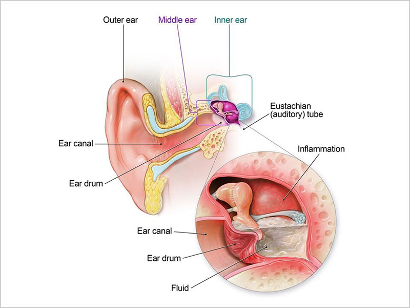 Bệnh kéo dài gây suy giảm thính giác