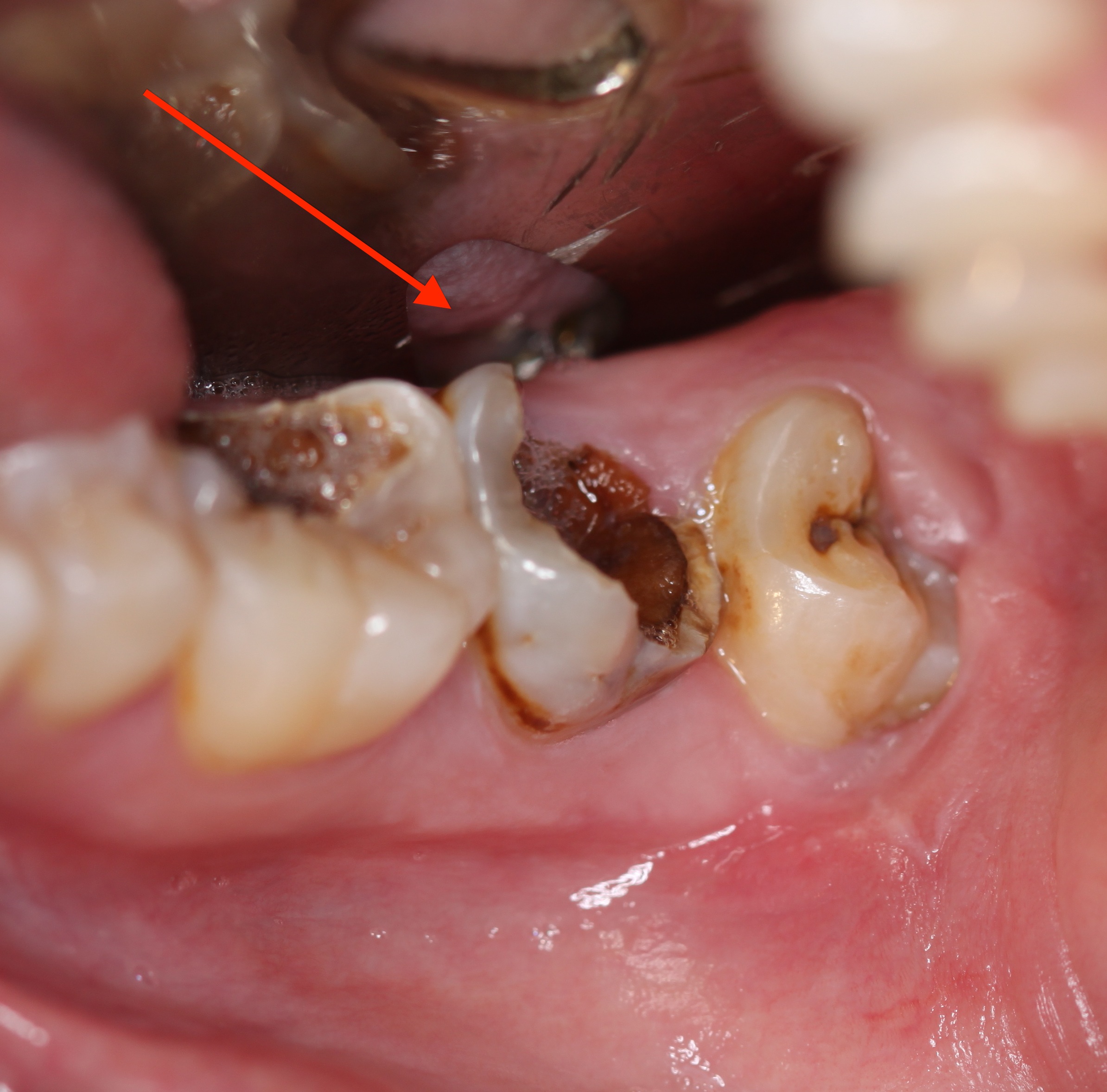 Nếu không điều trị kịp thời, bạn có thể bị mất răng vì viêm tủy 