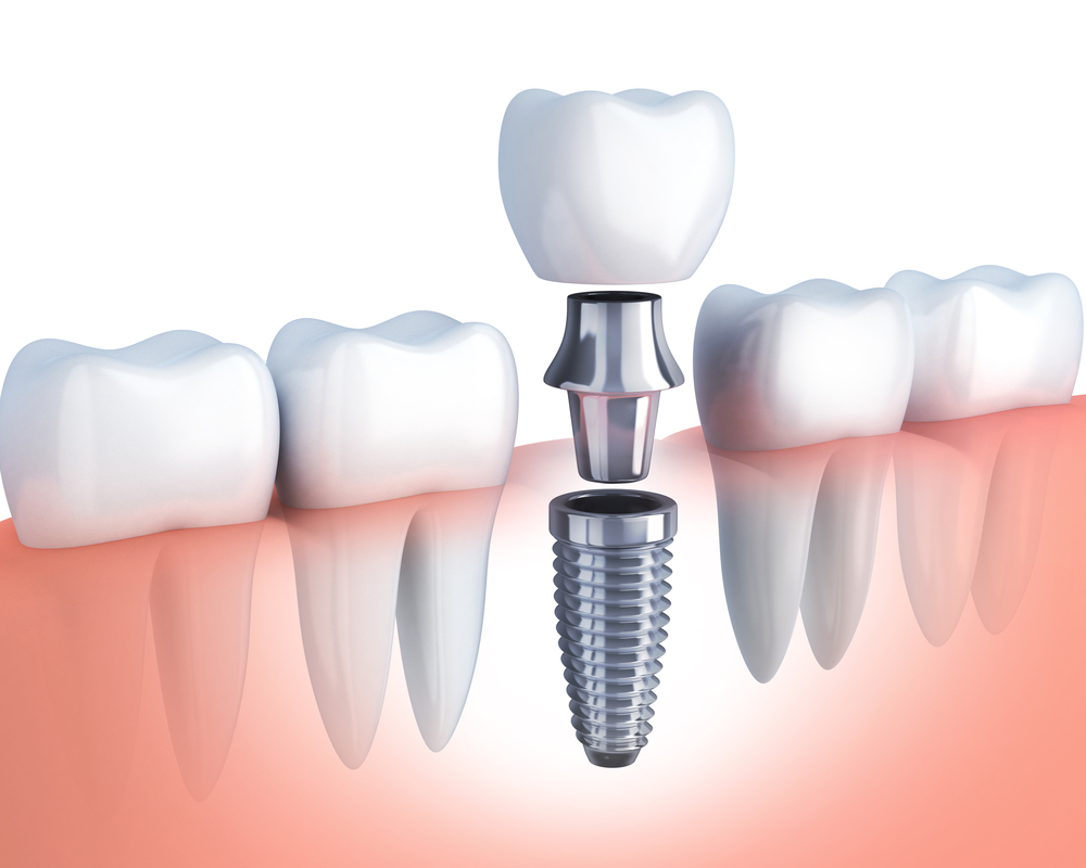 Cấy răng Implant để giúp người bệnh có thể ăn uống như bình thường 