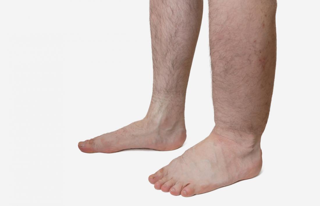 Bàn chân bị phù do dịch tích tụ 