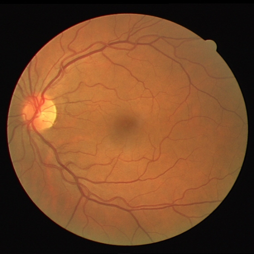 Retina Blood Vessel Segmentation Using Unet In Pytorch Image Hot Sex Picture