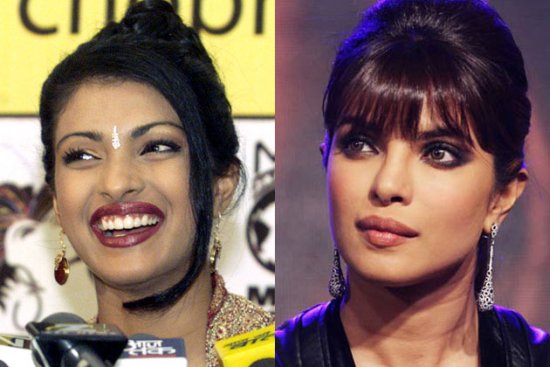 Priyanka-Chopra surgery