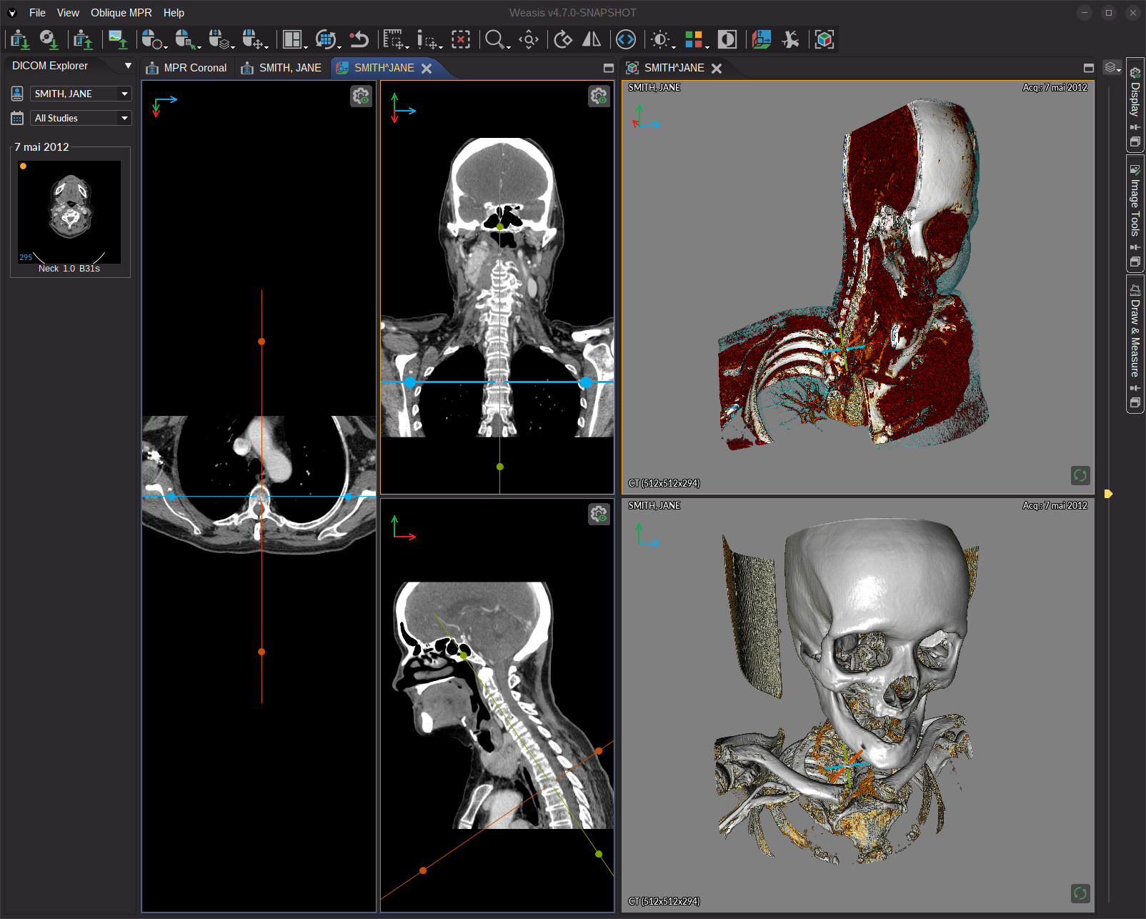 Weasis DICOM viewer