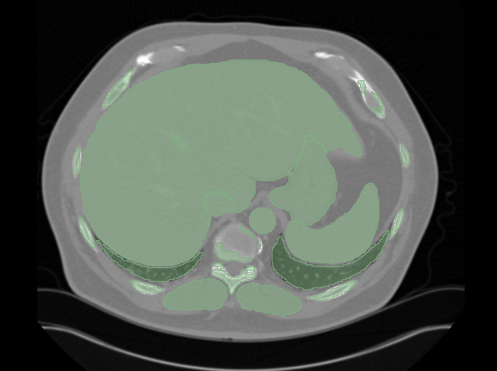 DICOM Segmentation Slice