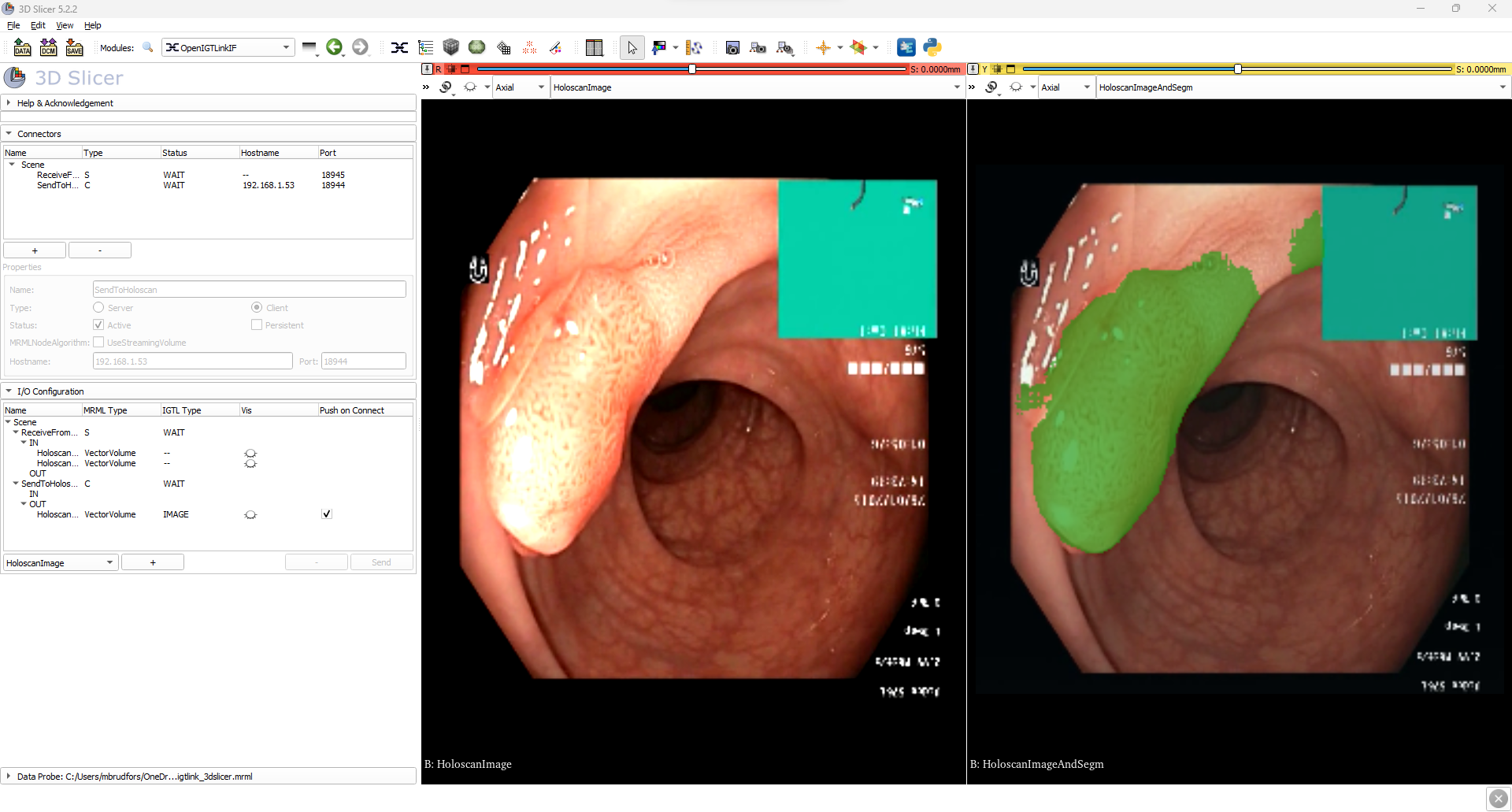 Python colonoscopy segmentation result