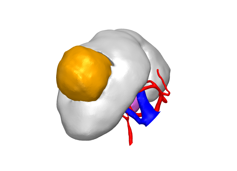 3D model of kidney tumor case