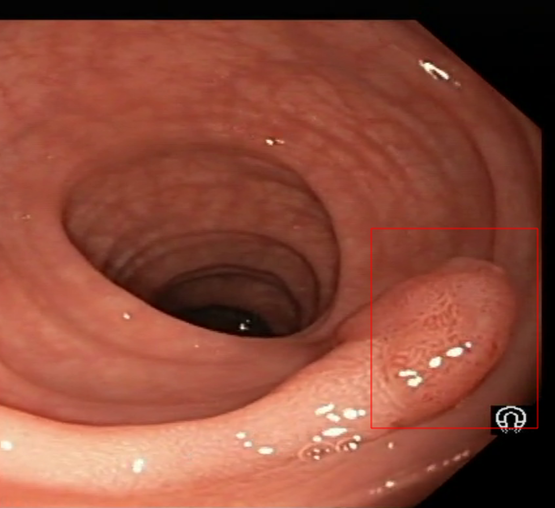 Polyp Detection