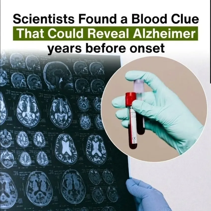 Alzheimer's Blood Test