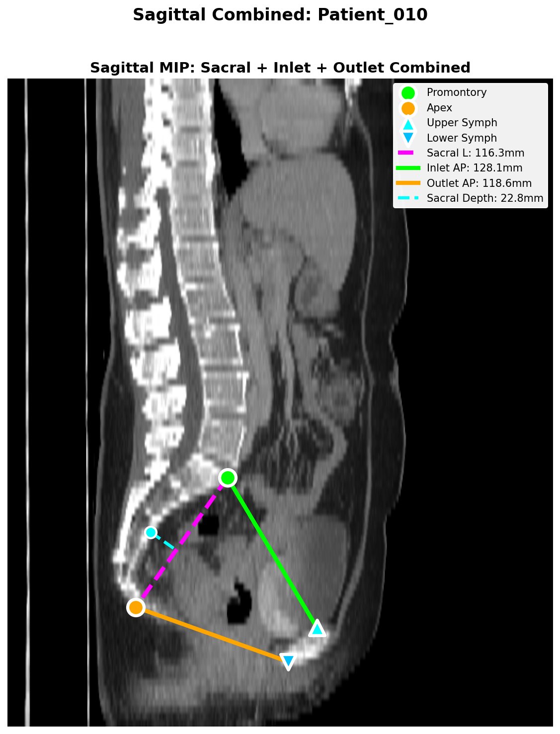 QC Example — Sagittal pelvimetry with automated landmark detection
