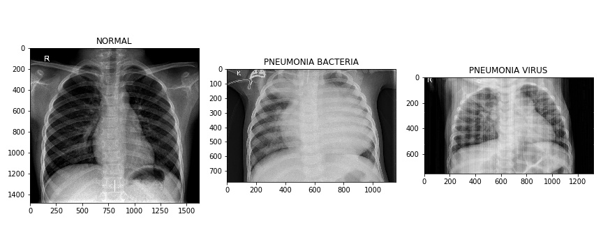 pneumonia