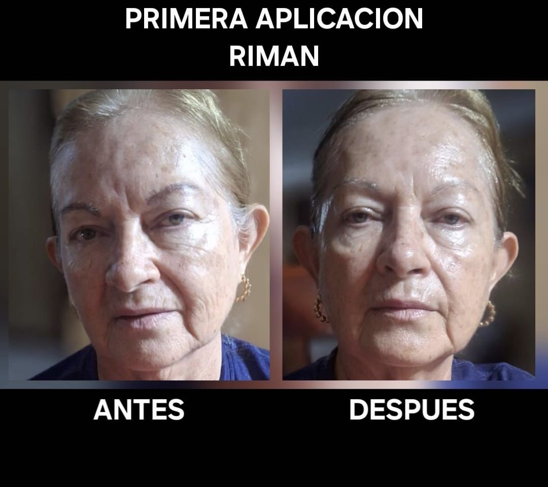 Testimonio RIMAN real: mejora en manchas y uniformidad de tono