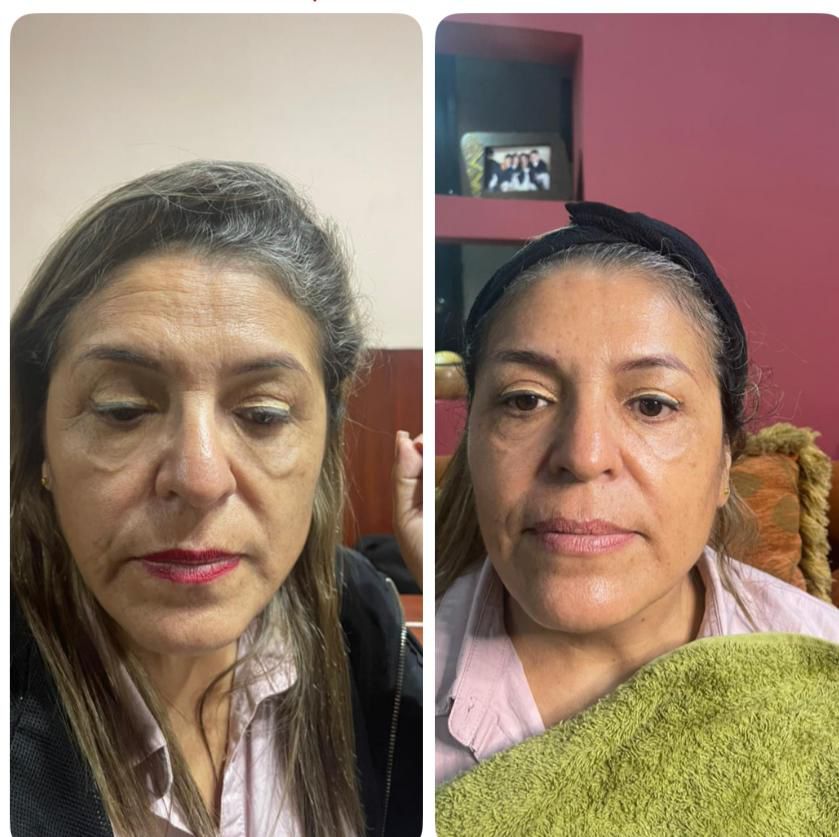 Resultado RIMAN real: reducción de poros y enrojecimiento