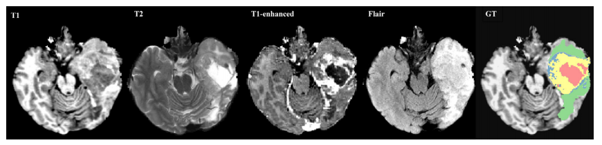 Brain Tumor MSD dataset
