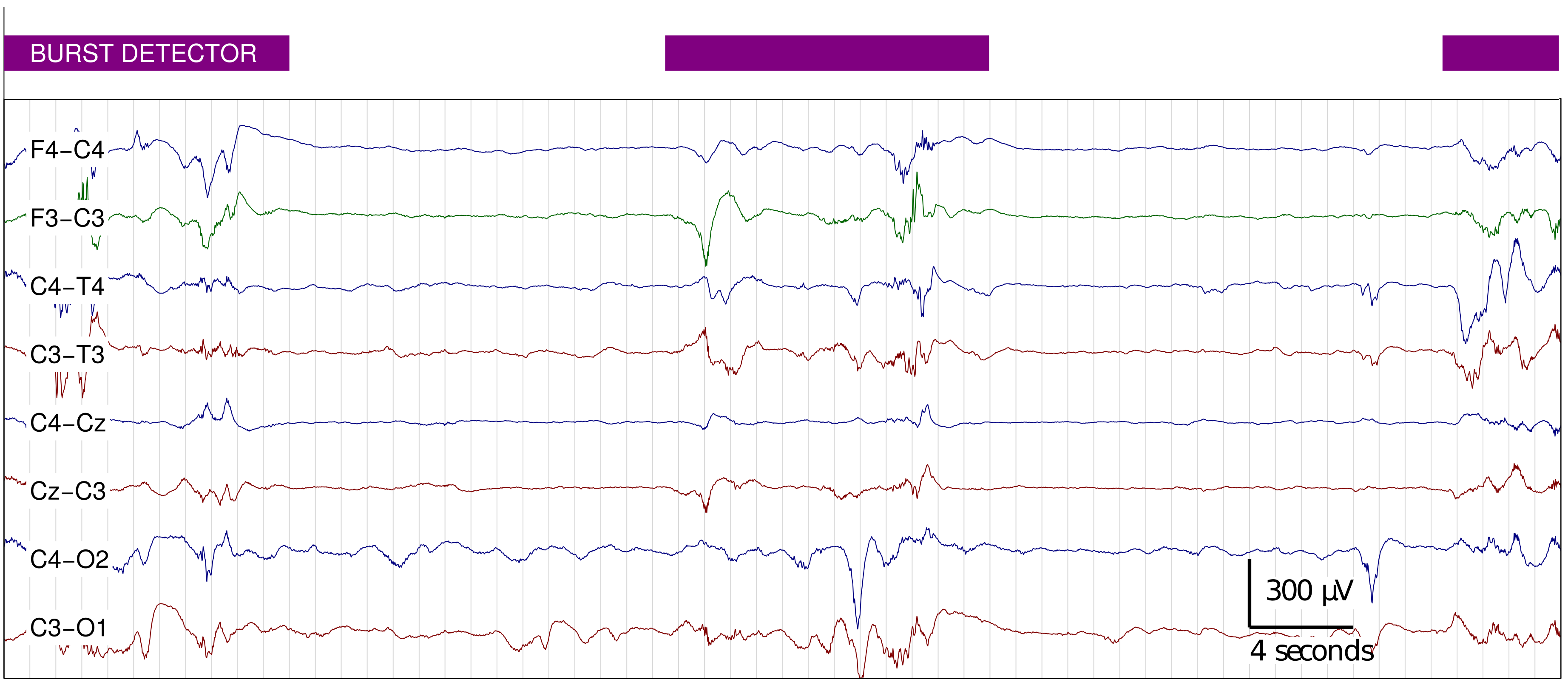 Example of burst detector (purple annotation) on channel F3-C3