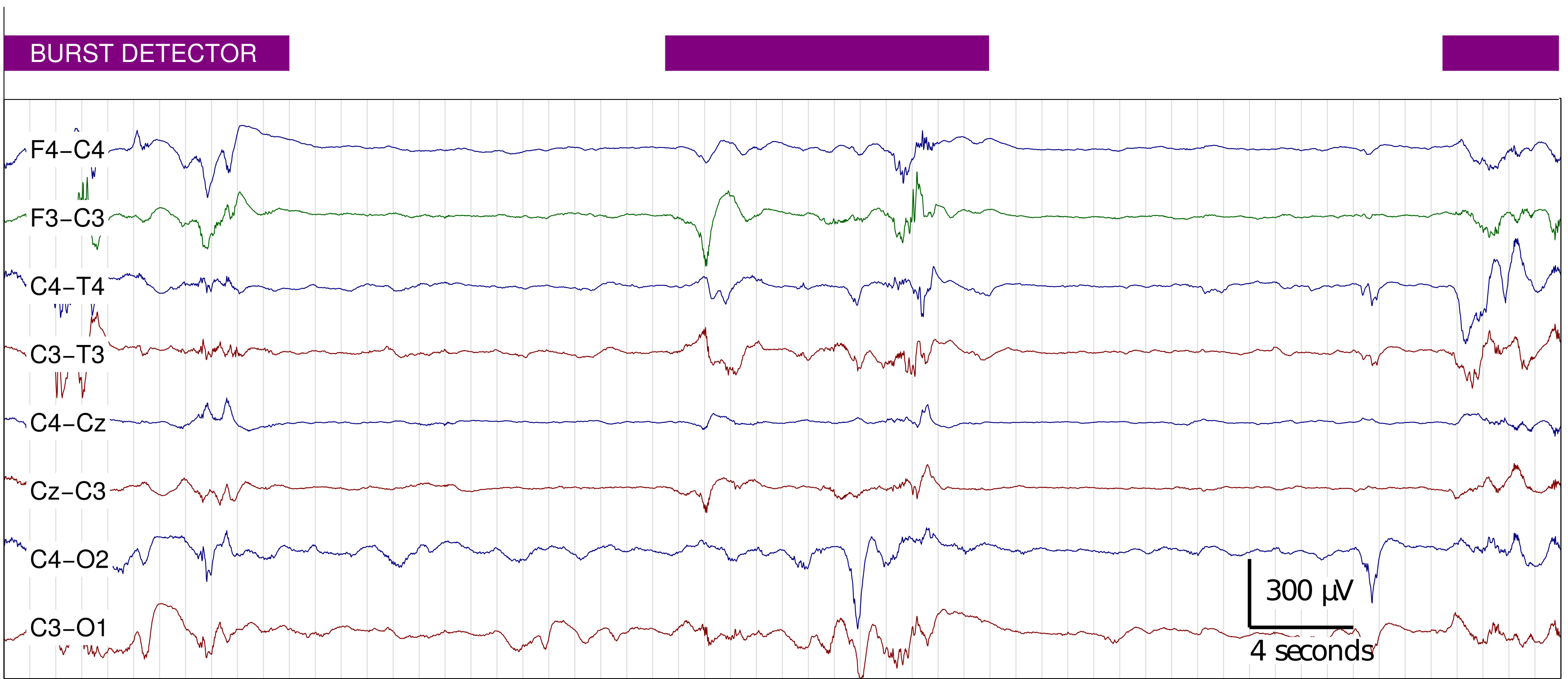 Example with EEG from a preterm infant, from burst detector http://otoolej.github.io/code/burst_detector/