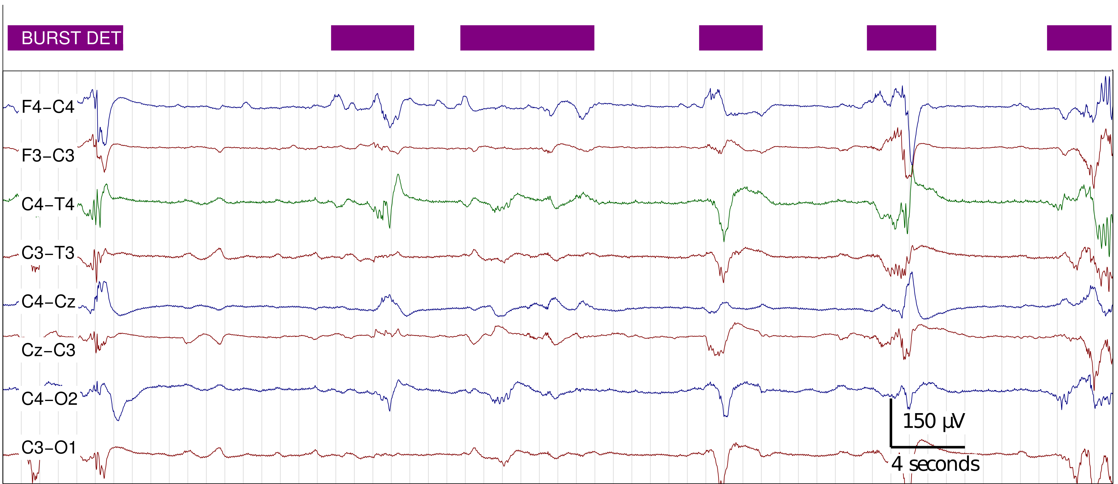 Another example of burst detector on channel C4-T4