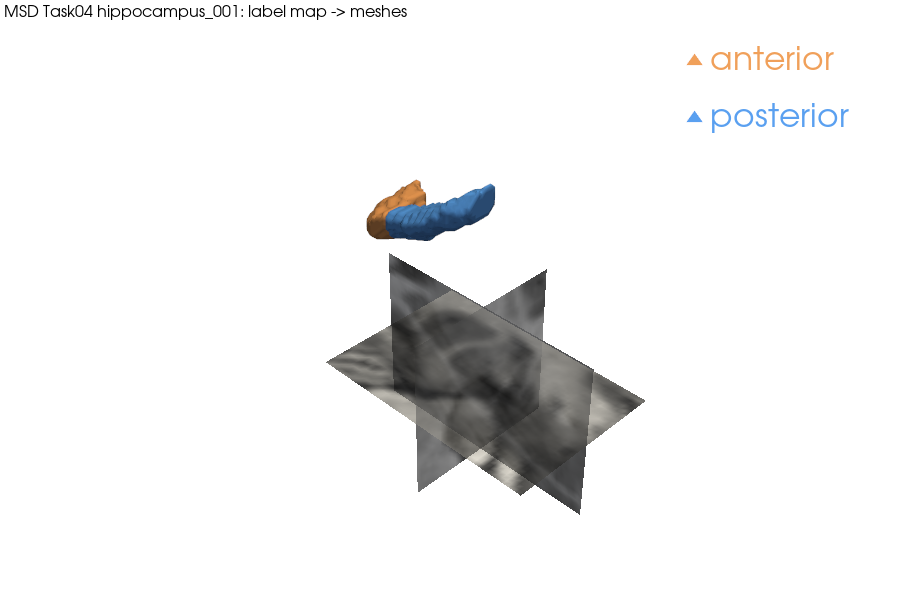 Hippocampus meshes over MRI slices