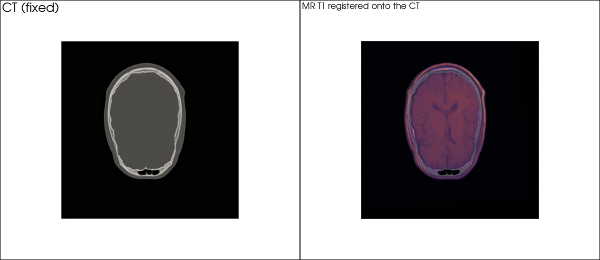 CT slice and registered MR overlay