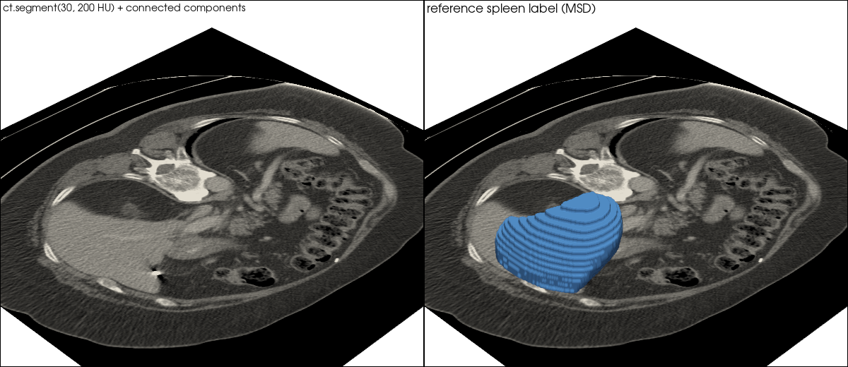 Threshold segmentation vs reference spleen label
