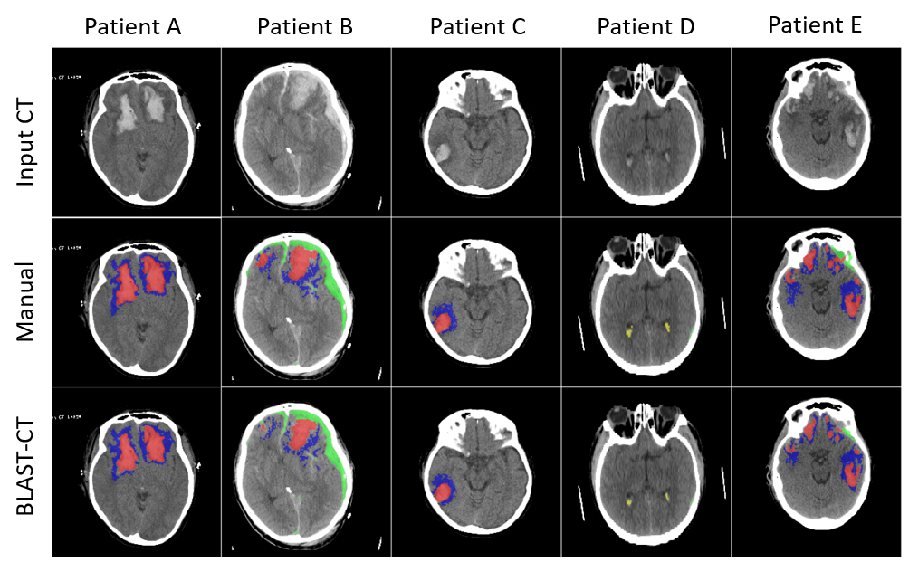 Examples for automatic lesion segmentation