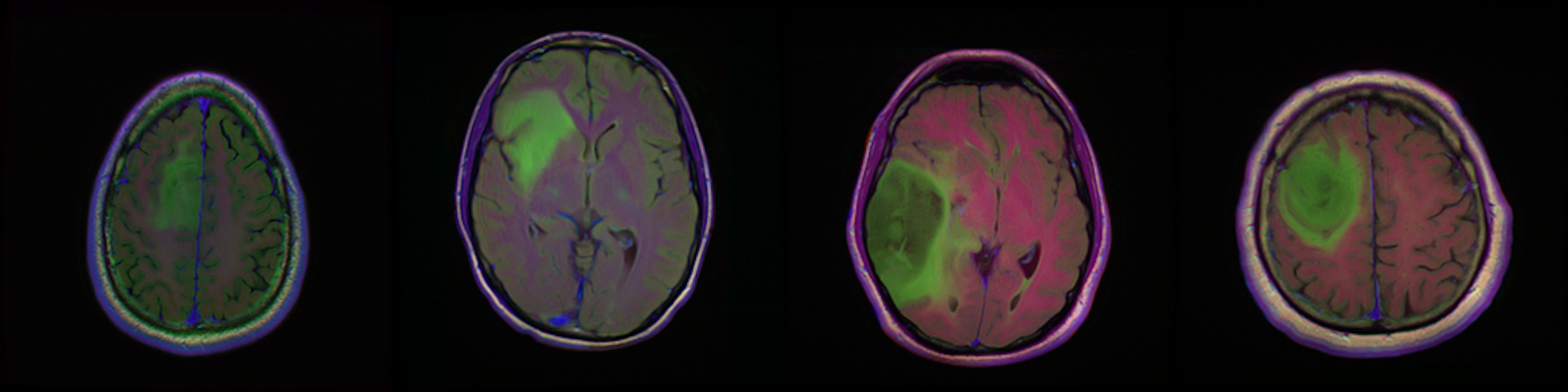 brain-mri-lgg