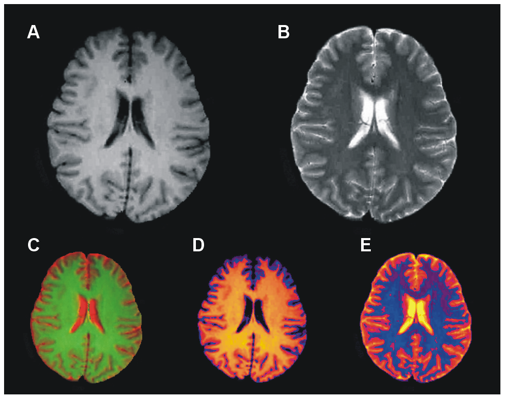 T2 MR Brain Images. From: Colorization and Automated Segmentation of Human T2 MR Brain Images for Characterization of Soft Tissues