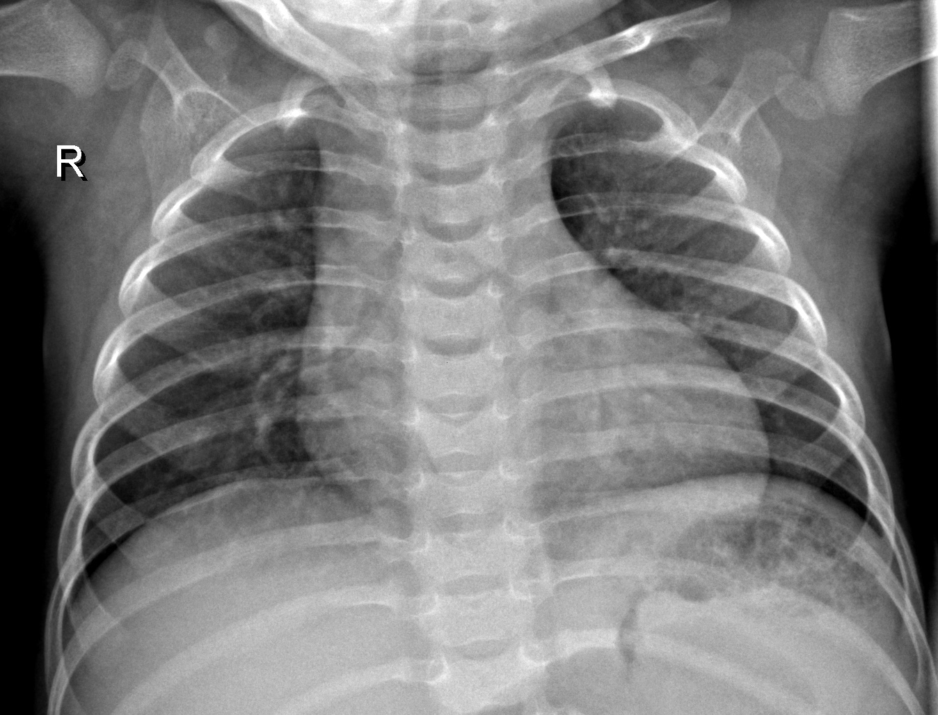 Chest X-ray with no Pneumonia