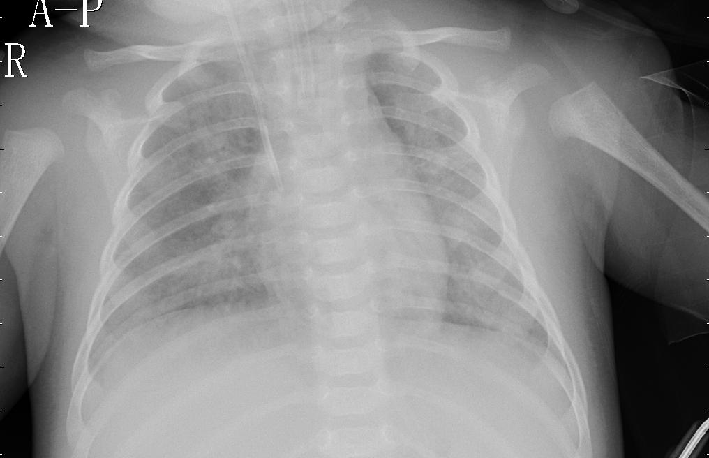 Chest X-ray with Pneumonia