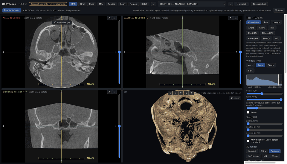 An AI agent driving CBCTScope over MCP on a real CBCT: slice navigation down to the dentition, window presets, a bone 3D render, then the multi-slice grid, curved panoramic with cross-sections, TMJ, reslice and virtual cephalogram