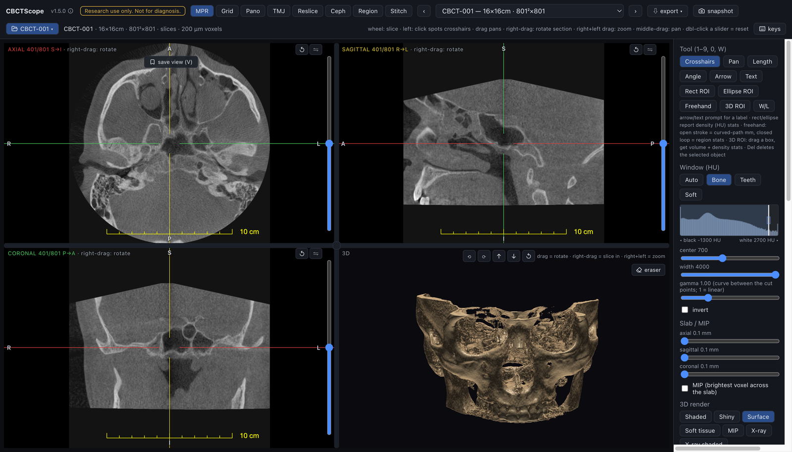 MPR: axial, sagittal, coronal and a bone 3D render, crosshairs on a molar, HU windowing, slab and MIP controls