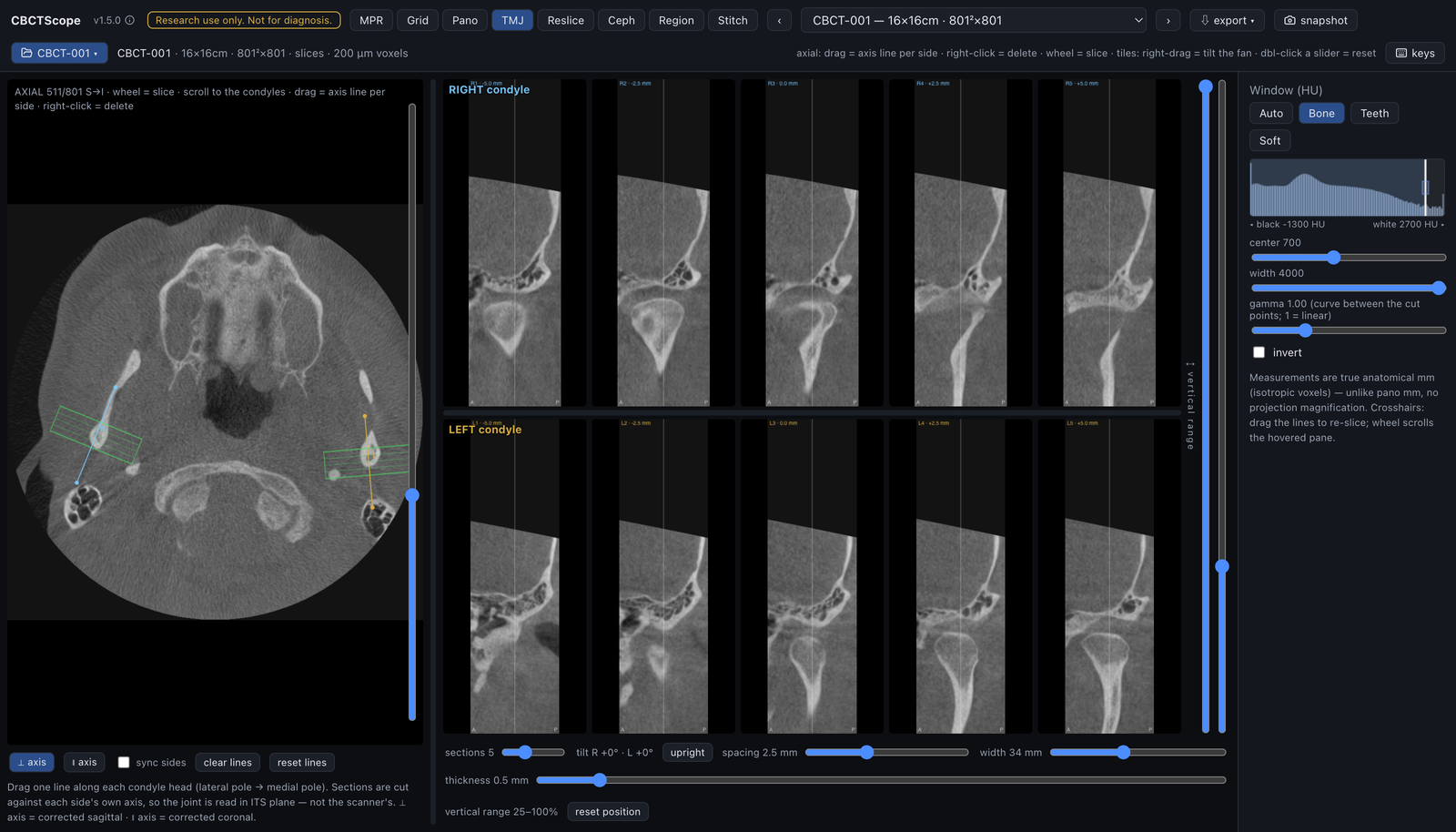 TMJ: both condyles in axis-corrected sagittal sections, five per side, with the axis line drawn per condyle on the axial scout