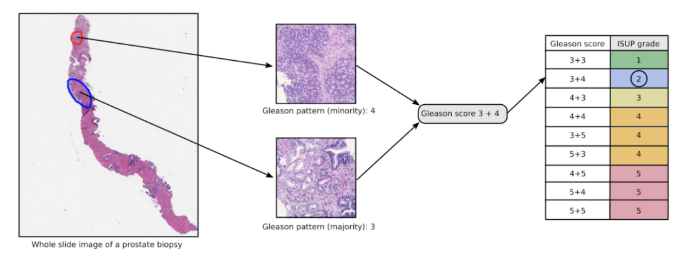 Example Biopsy Sample and the grading system