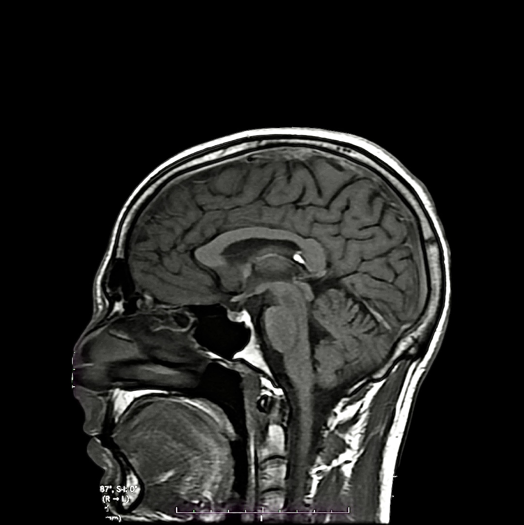 Neuromelanin-sensitive MRI
