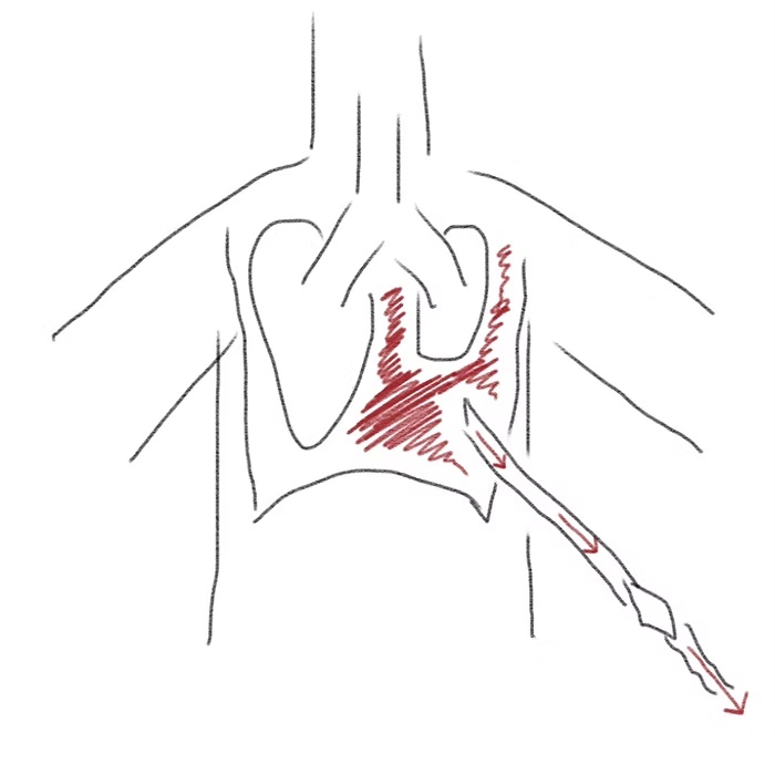 chest tube sketches