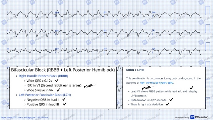 10_RBBB_and_LPFB_findings