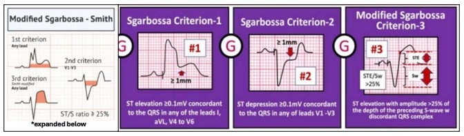 13_sgarbossa_criteria