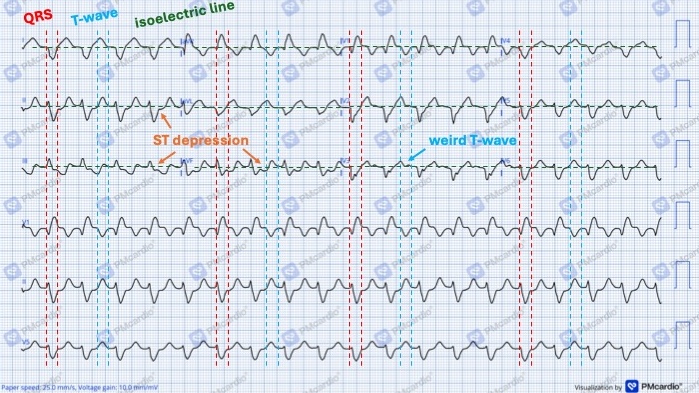 2_annotated_EKG