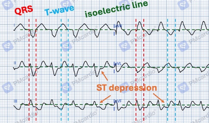 3_EKG_zoomed_in