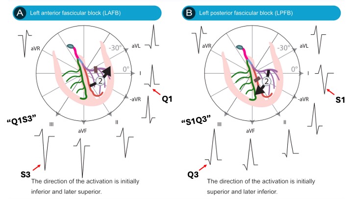 8_hemiblocks_ecgwaves