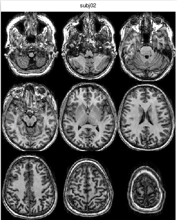 Example MRI