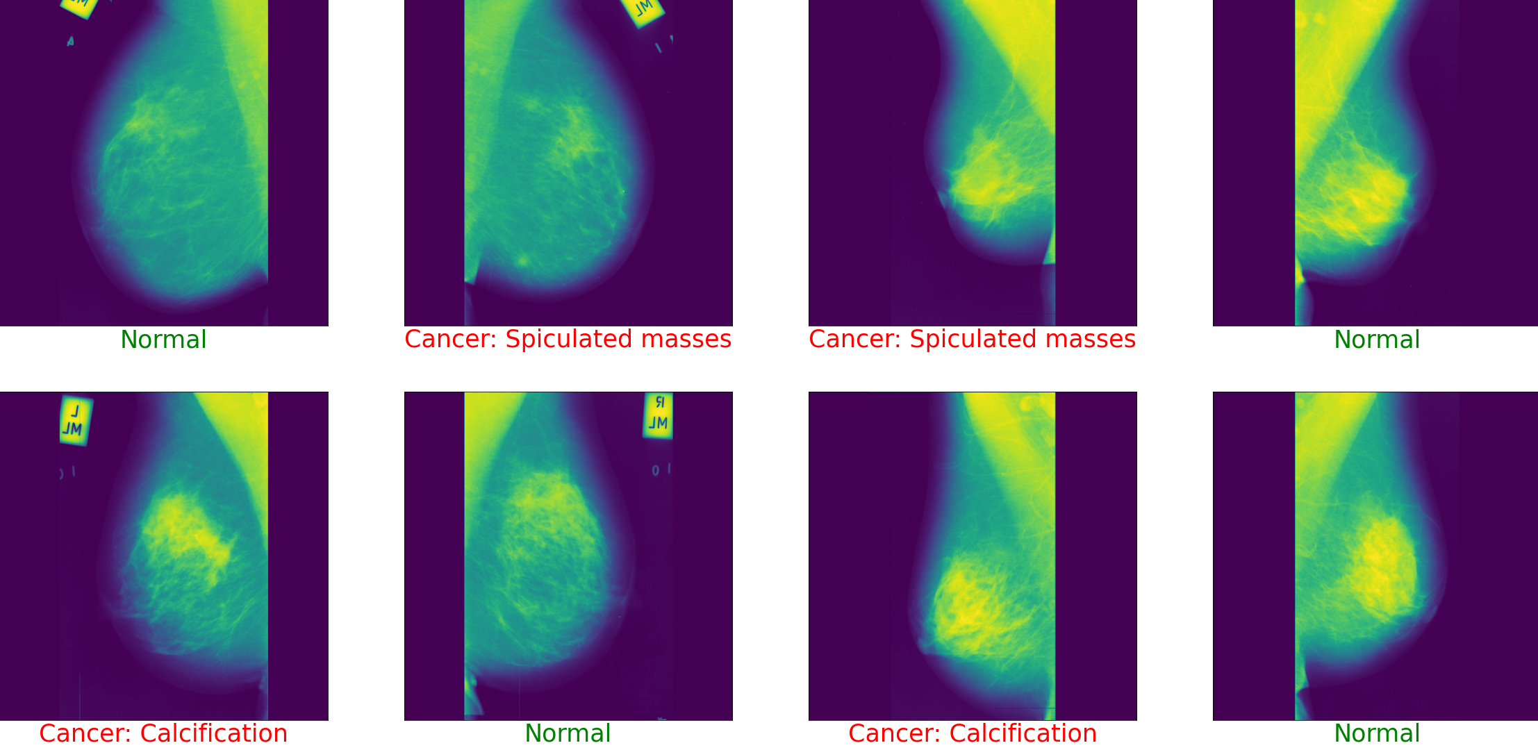 Breast Cancer Predictions