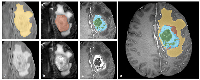 Brain tumors