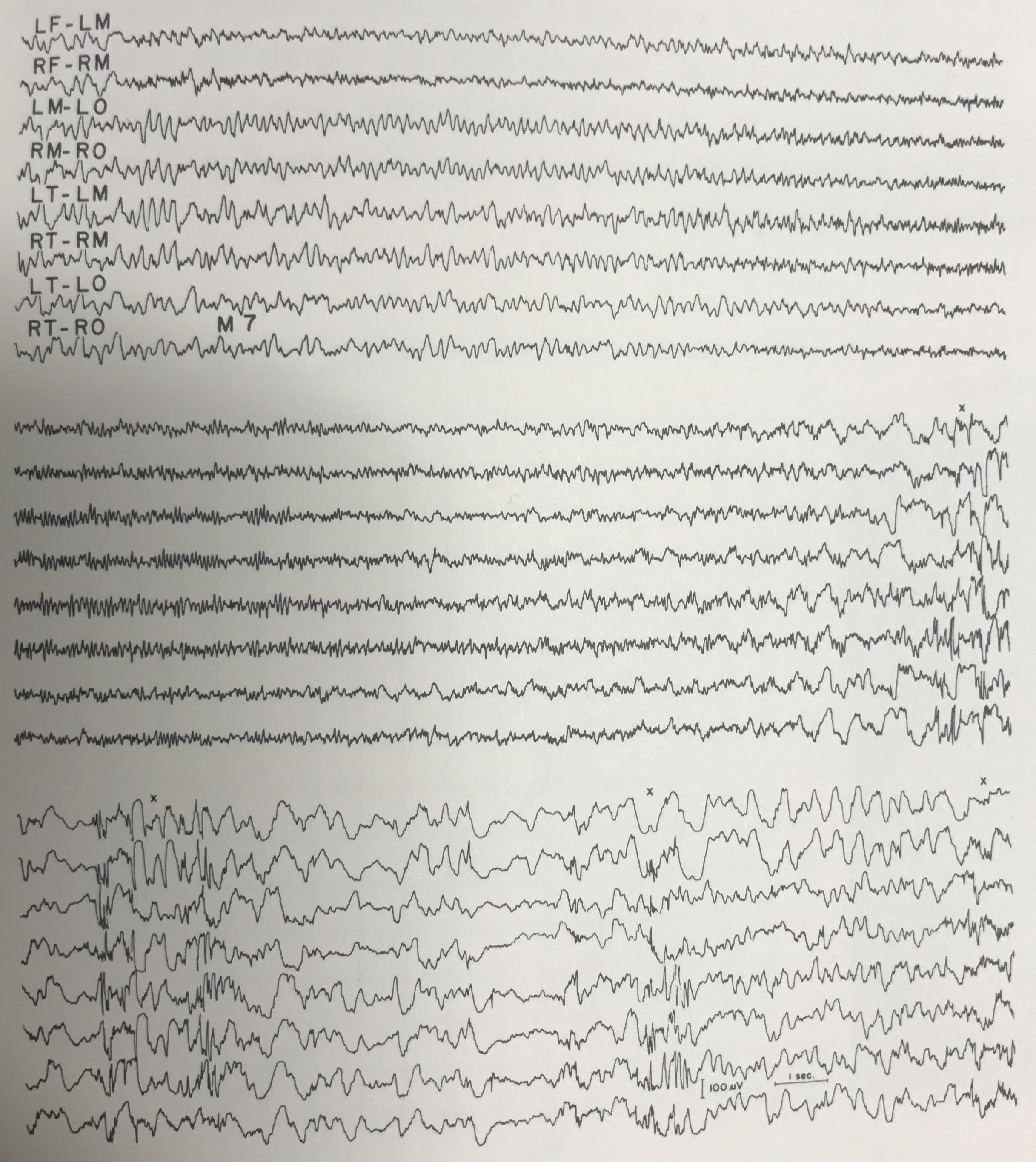 ecg