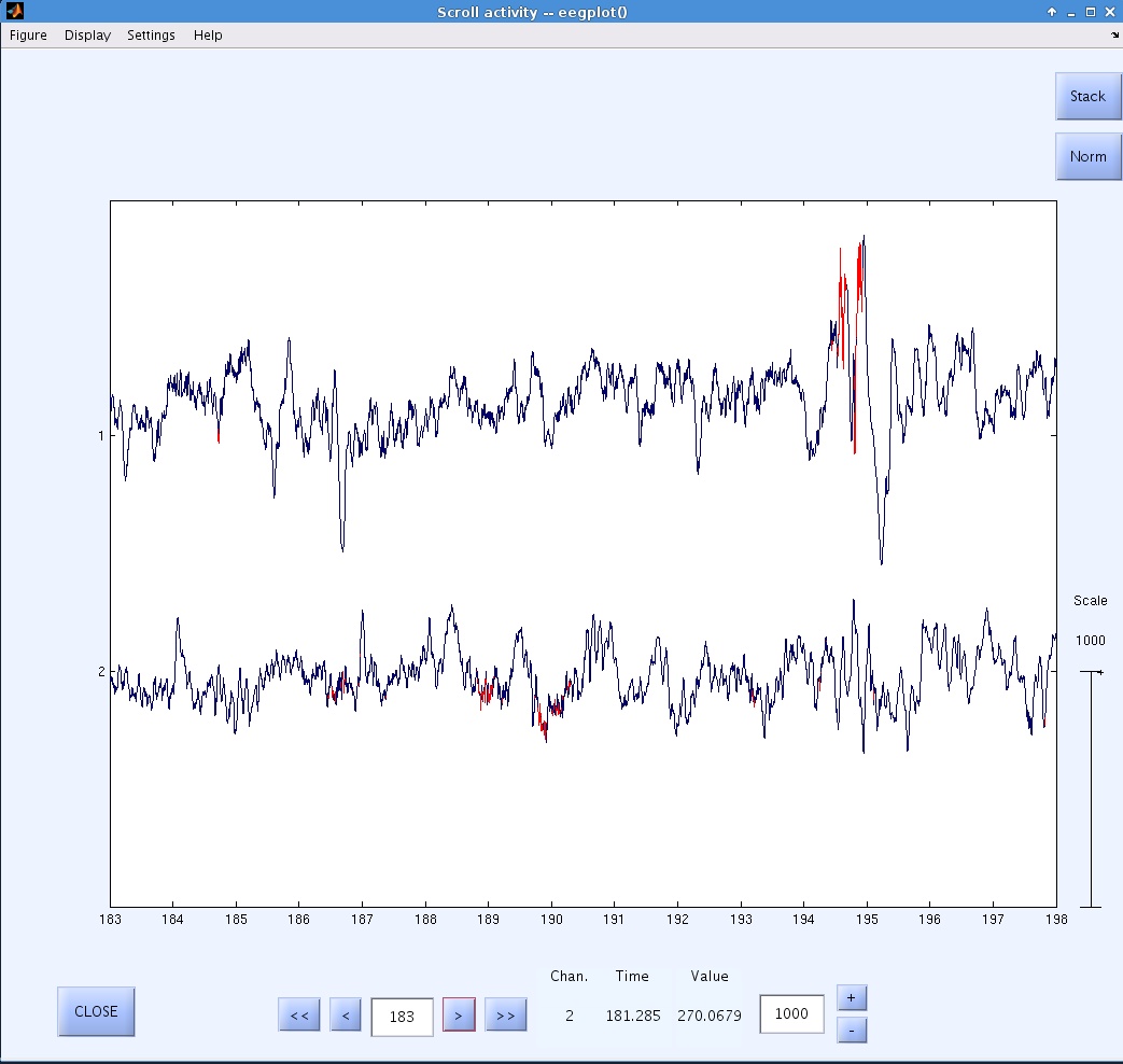 Figure 3. Detected HFOs (shown in
red).