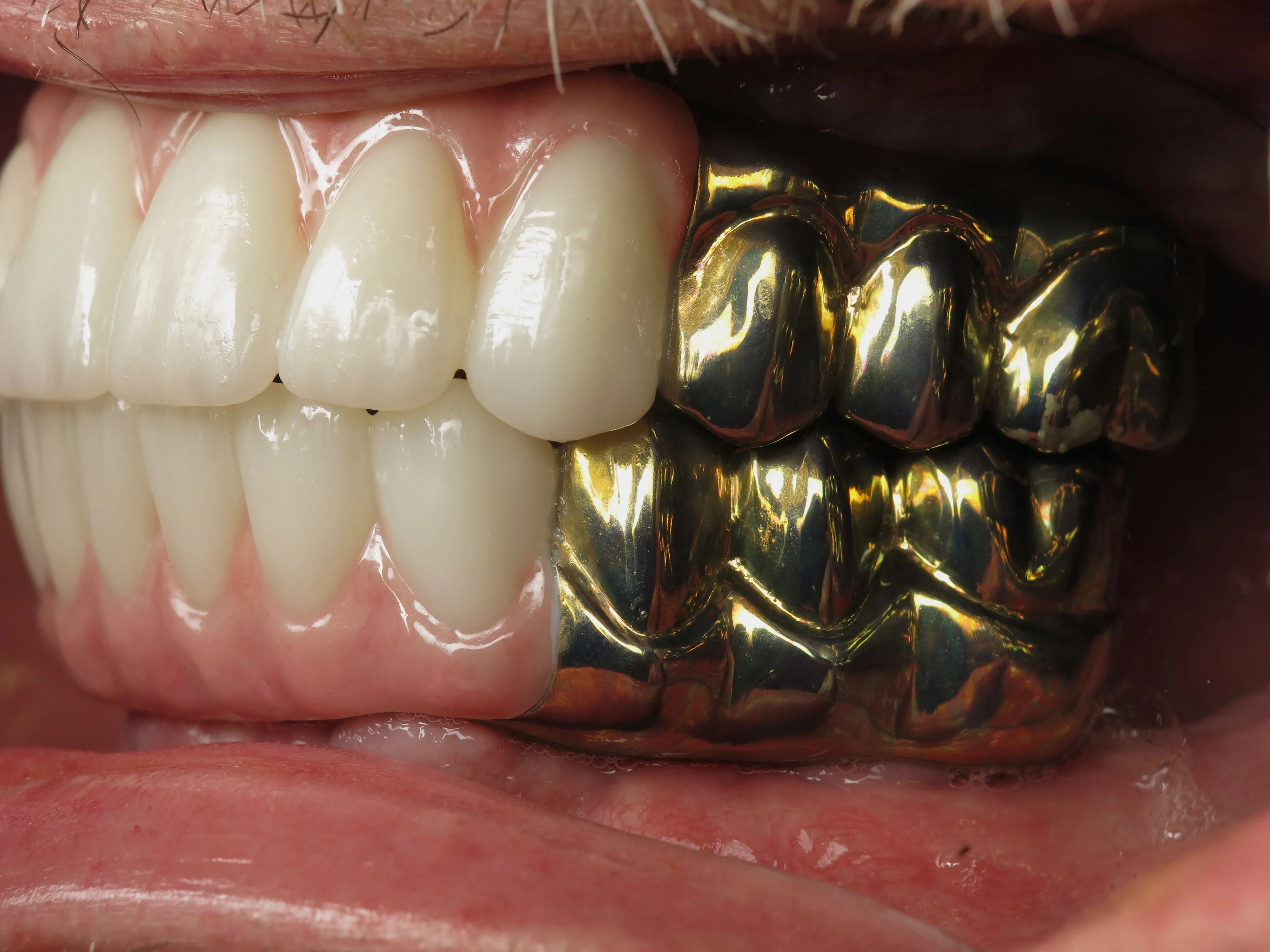 Custom gold All-on-X close-up detail