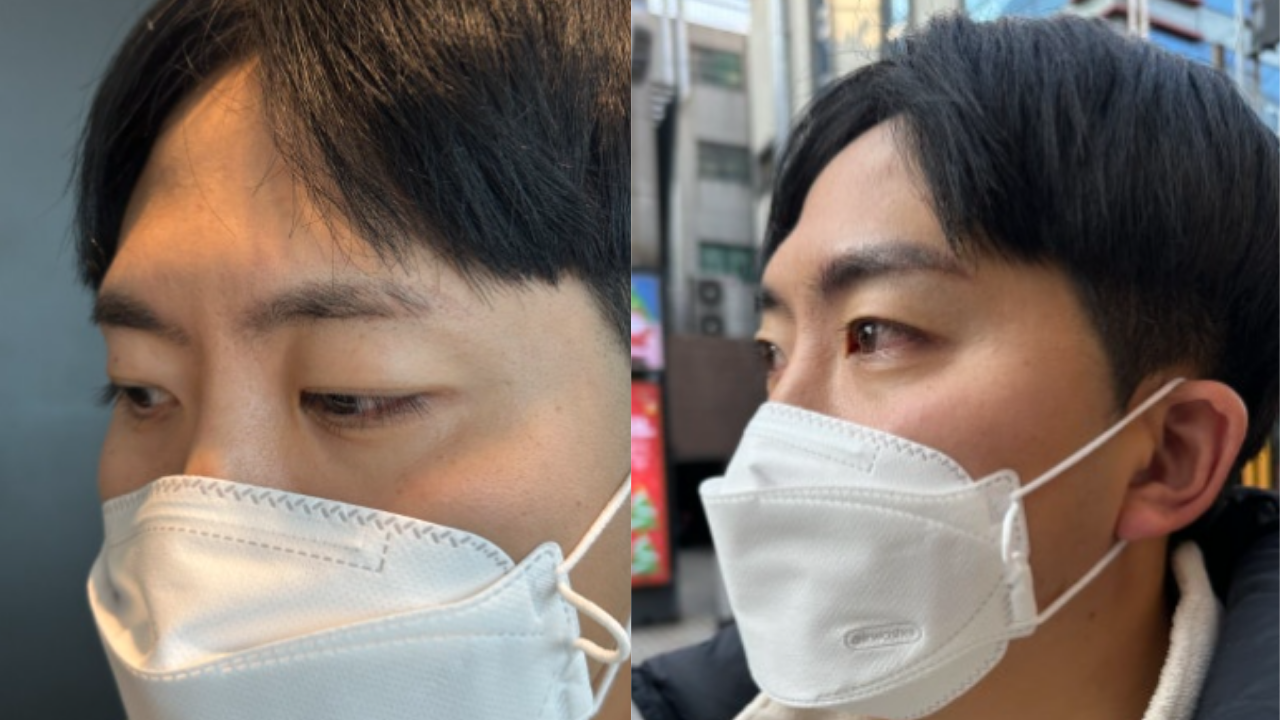 시술 다음날 후기